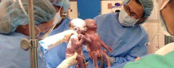 Близначки се родиха хванати за ръка като „най-добри приятелки”